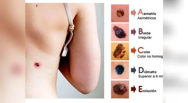 Se recomienda hacerse un autoexamen de forma periódica Se recomienda hacerse un autoexamen de forma periódica