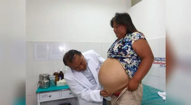 Mujer que vivía con hernia de 30 centímetros se recupera satisfactoriamente Mujer que vivía con hernia de 30 centímetros se recupera satisfactoriamente