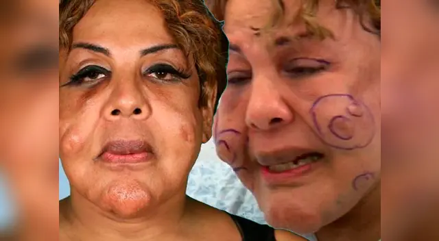 Rajee Narinesingh cayó en una profunda depresión tras inyectarle cemento en el rostro