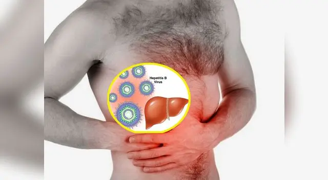 La hepatitis B afecta al hígado y es causada por un virus llamado VHB La hepatitis B afecta al hígado y es causada por un virus llamado VHB