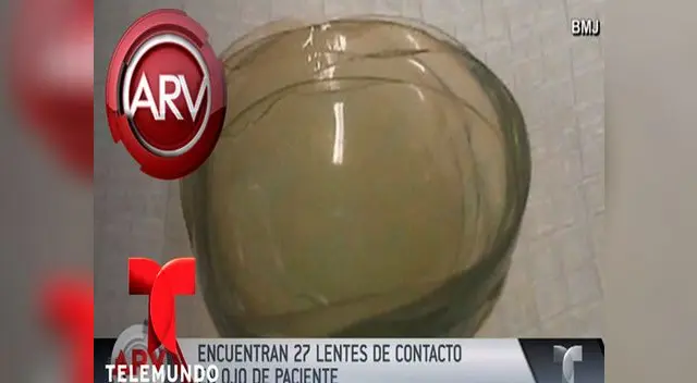 Anciana tenía 27 lentes de contacto en un ojo