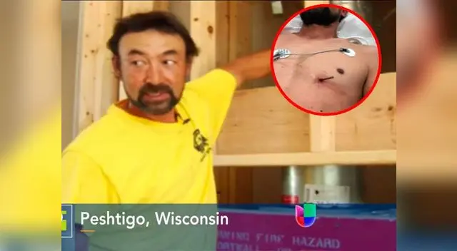 Hombre sobrevivió a su clavo incrustado en su pecho de manera milagrosa Hombre sobrevivió a su clavo incrustado en su pecho de manera milagrosa