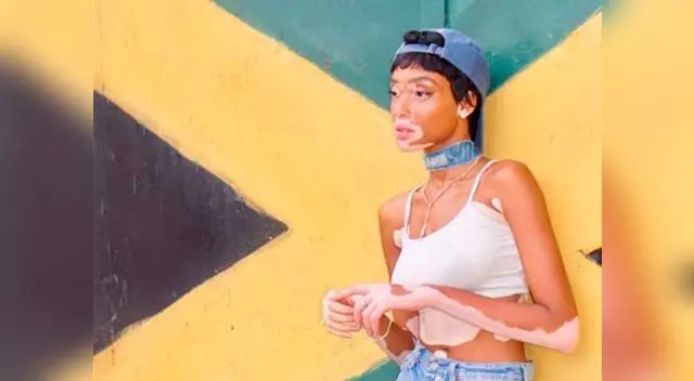 Modelo con vitíligo se muestra como dios la trajo al mundo Modelo con vitíligo se muestra como dios la trajo al mundo