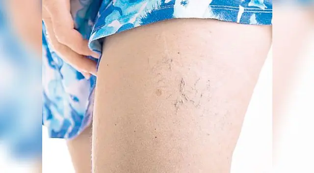 ¿Qué son, cómo evitarlas y cómo podemos tratarlas?