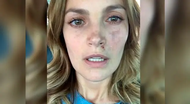 Juliana Galvis resultó con terribles heridas en rostro y piernas Juliana Galvis resultó con terribles heridas en rostro y piernas