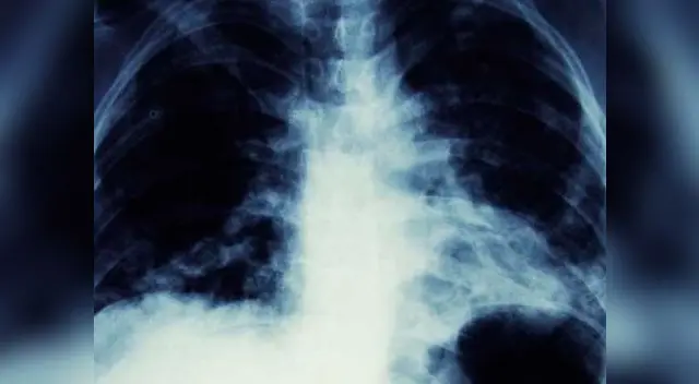 Hombre creía tener cáncer de pulmón, pero los médicos le detectaron algo inesperado Hombre creía tener cáncer de pulmón, pero los médicos le detectaron algo inesperado