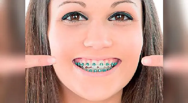 ¿Cómo sé si necesito usar bráckets?