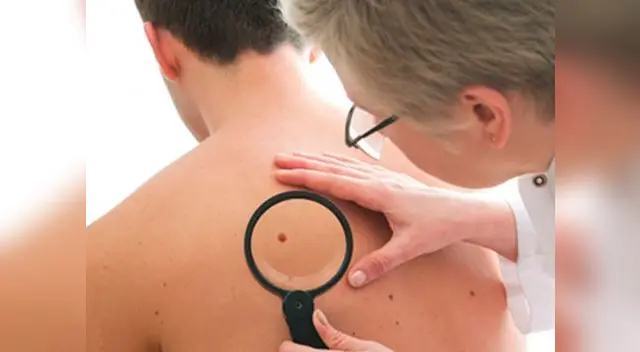 ¿Cómo distinguir un lunar cancerígeno?