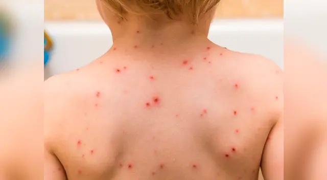 Más de mil niños contrajeron varicela en lo que va del año