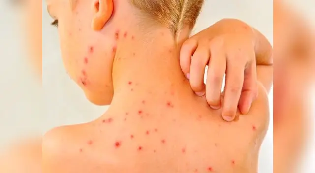 La varicela es una infección viral contagiosa que está en el ambiente 