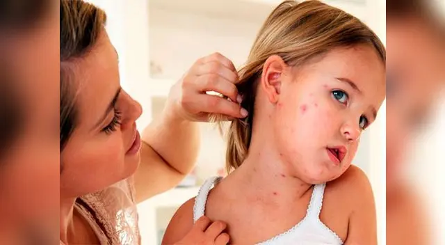 La vacuna contra la varicela es colocada sólo a niños de 1 año (hasta 1 año, 11 meses y 29 días) de manera gratuita