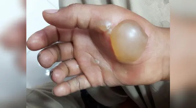 El padre Nils Silva Castillo es investigado por el Ministerio Público de Tambopata por quemar manos de su hijo