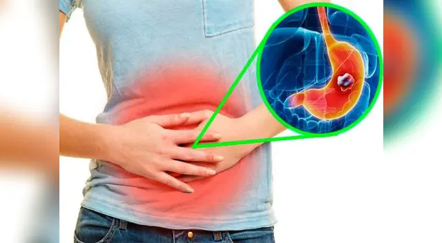 En la mayoría de casos el cáncer de estómago es causado por la infección de la bacteria Helicobacter pylori En la mayoría de casos el cáncer de estómago es causado por la infección de la bacteria Helicobacter pylori