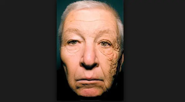 Camionero envejeció de un solo lado del rostro por el sol