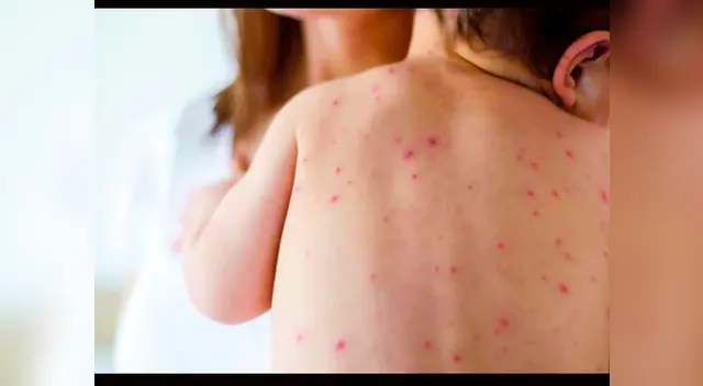 El Ministro de Brasil también confirmo que se han registrado tres muerte por sarampión El Ministro de Brasil también confirmo que se han registrado tres muerte por sarampión