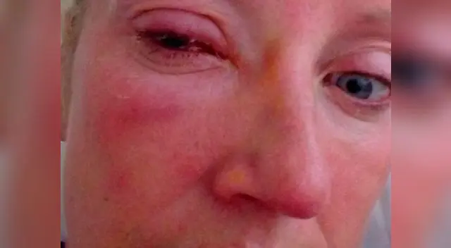 La víctima dijo que la falta de visión fue "bastante inmediata". | FOTO: referencial