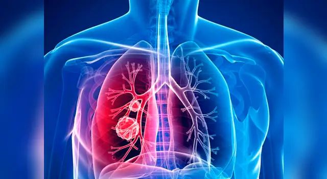 El cáncer de pulmón tiene la más alta de mortalidad a nivel mundial
