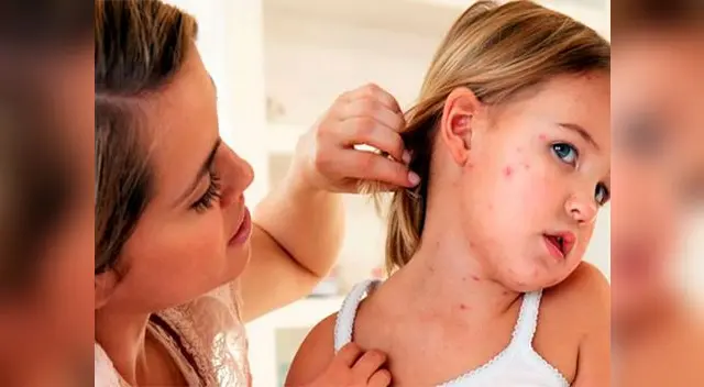 En lo que va del año se han reportado más de 7 mil casos de varicela a nivel nacional