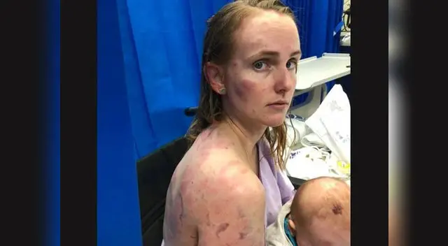 Así quedó cuerpo de mujer tras tormenta de granizo Así quedó cuerpo de mujer tras tormenta de granizo