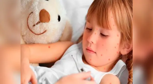 La varicela se transmite de una persona infectada a otra sana, a través de su saliva y flujos nasales, o tocando sus ampollas La varicela se transmite de una persona infectada a otra sana, a través de su saliva y flujos nasales, o tocando sus ampollas