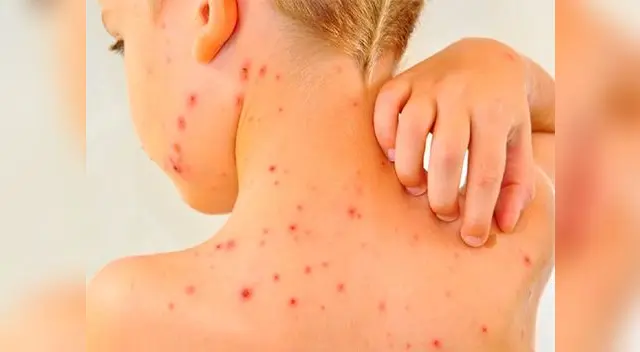 La vacuna es la única medida para combatir con garantía la propagación de la enfermedad en una comunidad vulnerable