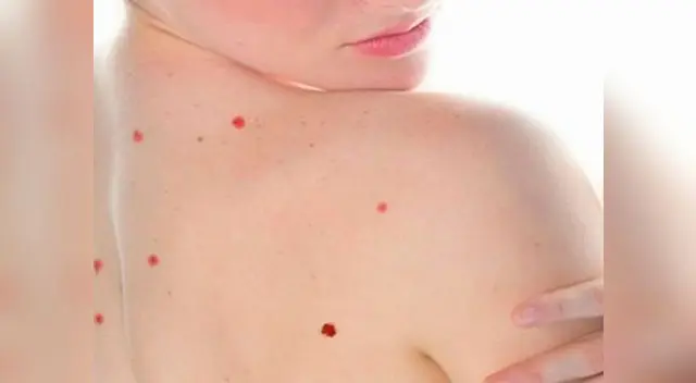 Esté atento a los cambios que puedan tener estos lunares