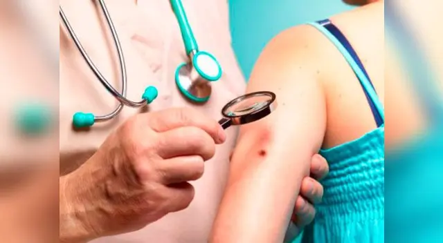 Debemos estar más atentos a los cuidados que necesita nuestra piel, la incorrecta exposición al sol puede generar la aparición de lunares malignos Debemos estar más atentos a los cuidados que necesita nuestra piel, la incorrecta exposición al sol puede generar la aparición de lunares malignos