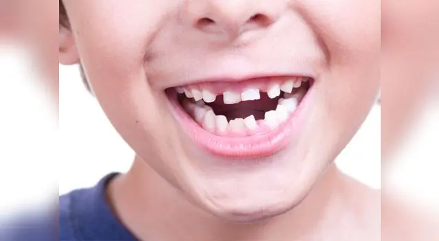 Es recomendable tratar la oclusión (mala mordida) desde temprana edad