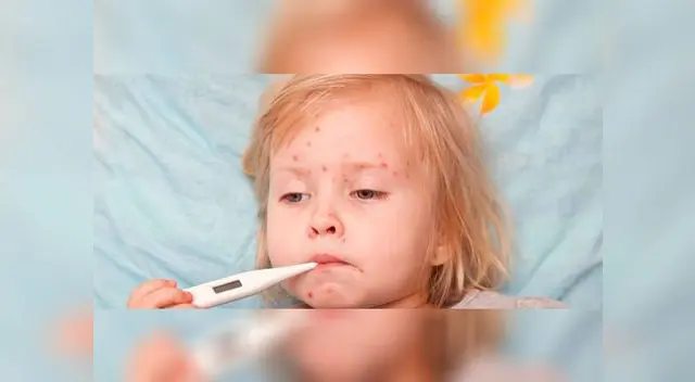 Gracias a la vacuna contra la varicela cada vez hay menos niños que contraen esta enfermedad y los que la contraen la pasan muy levemente