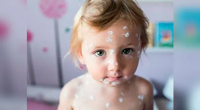 La vacuna contra la varicela es una de las medidas más efectivas para prevenir la enfermedad