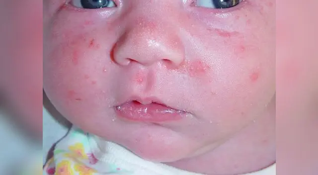 Se trata de una patología común de la piel que tiene lugar durante los tres primeros meses de vida