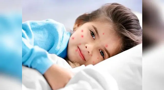 La varicela puede contagiarse a los adultos y suele ser más agresiva que en los niños La varicela puede contagiarse a los adultos y suele ser más agresiva que en los niños