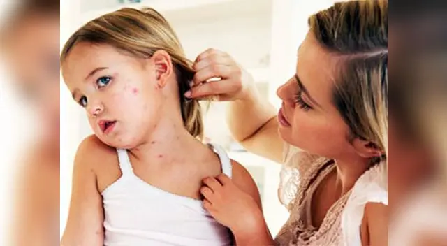 En lo que va del año se ha registrado un caso de sarampión y 1,336 nuevos casos de varicela En lo que va del año se ha registrado un caso de sarampión y 1,336 nuevos casos de varicela