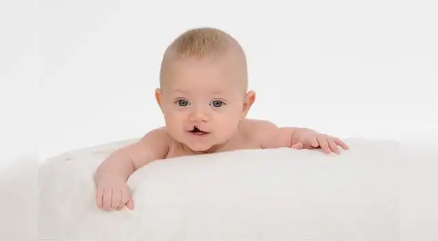 Es una malformación facial y oral que ocurre de forma realmente temprana en el embarazo Es una malformación facial y oral que ocurre de forma realmente temprana en el embarazo