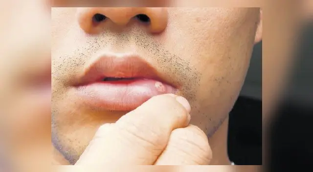 Es conveniente evitar el hábito de morder ciertos objetos, como bolígrafos, ya que el roce también provoca las llagas Es conveniente evitar el hábito de morder ciertos objetos, como bolígrafos, ya que el roce también provoca las llagas