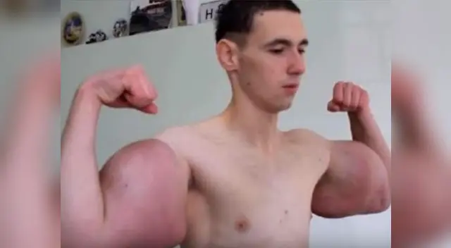 'Popeye Ruso' se operó para salvar su vida por tener 3 litros en cada brazo