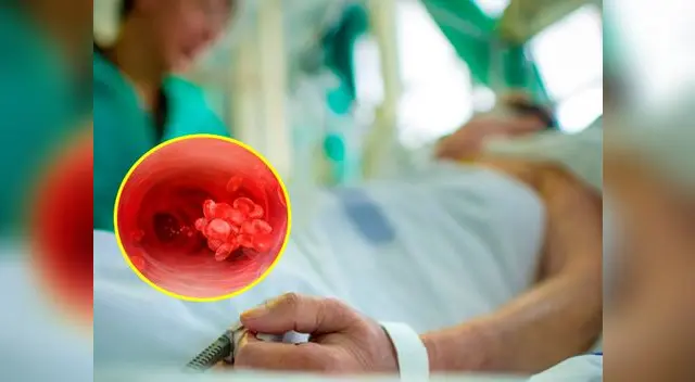 La septicemia es más frecuente y grave en personas con defensas debilitadas