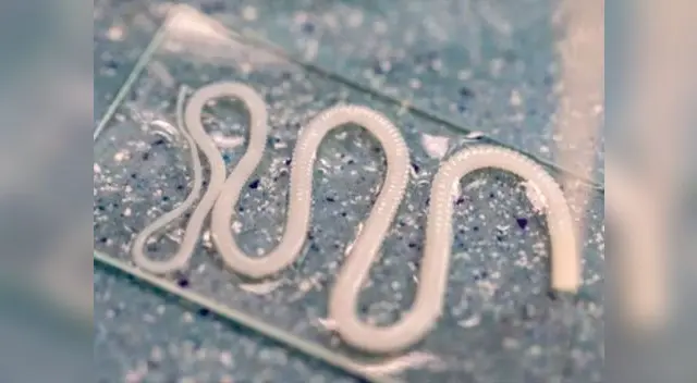 La lombriz solitaria se había alojado en el cerebro del paciente