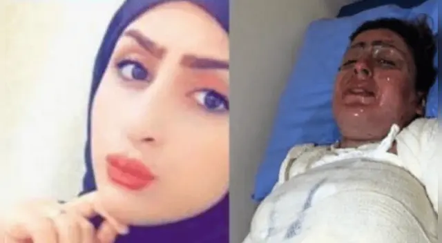 La joven quedó con graves ampollas por las quemaduras tras ser rociada con gasolina por el esposo.