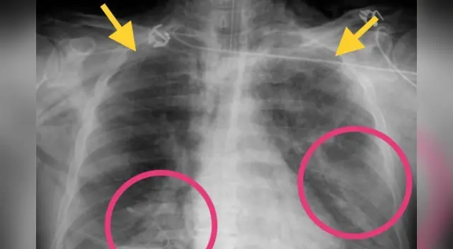 Las imágenes mostraron zonas de opacidad en los pulmones provocados por el covid-19.