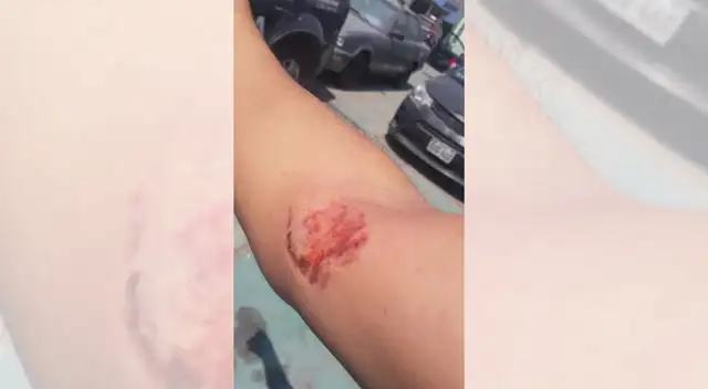 Sujeto mordió el brazo de un policía