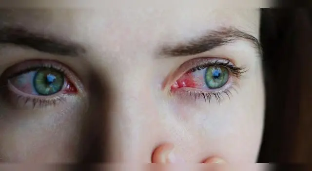 conjuntivitis sería uno de los primeros síntomas.