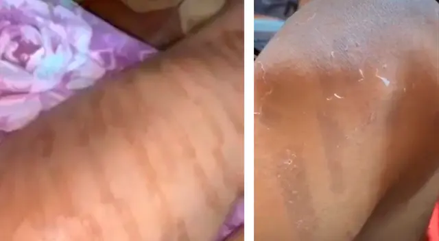 Mujer se somete a depilación láser y termina con la piel quemada. Mujer se somete a depilación láser y termina con la piel quemada.