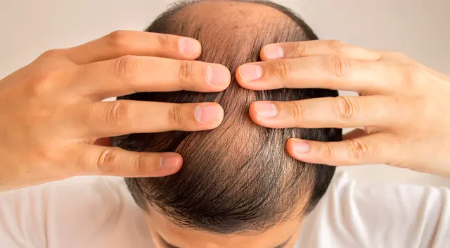Estudio señala que pérdida del cabello es factor de riesgo ante la COVID-19.