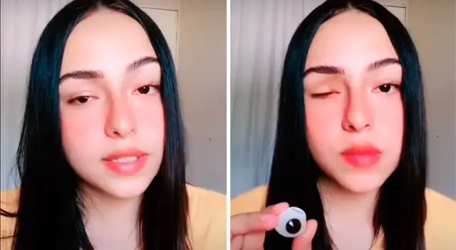 Joven mostrando su prótesis de ojo. Joven mostrando su prótesis de ojo.