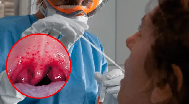 Sarpullido bucal. Sarpullido bucal.