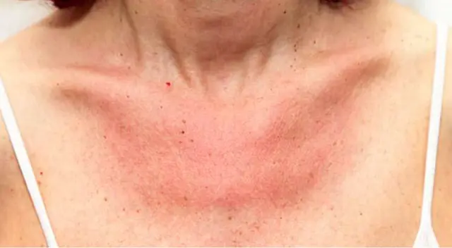 Erupciones cutáneas. Erupciones cutáneas.