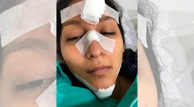 Ciclovía de Magdalena del Mar causó graves heridas en una joven. Ciclovía de Magdalena del Mar causó graves heridas en una joven.