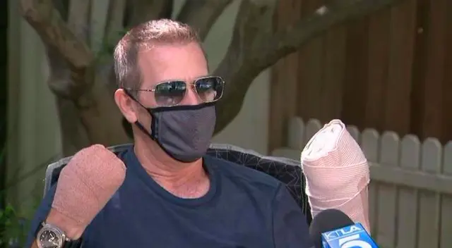 Hombre que se quedó sin dedos por el coronavirus cuenta su historia