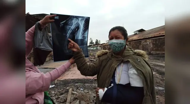 Mujer que rescató a su hijo del incendio pide ayuda para operarse el brazo Mujer que rescató a su hijo del incendio pide ayuda para operarse el brazo